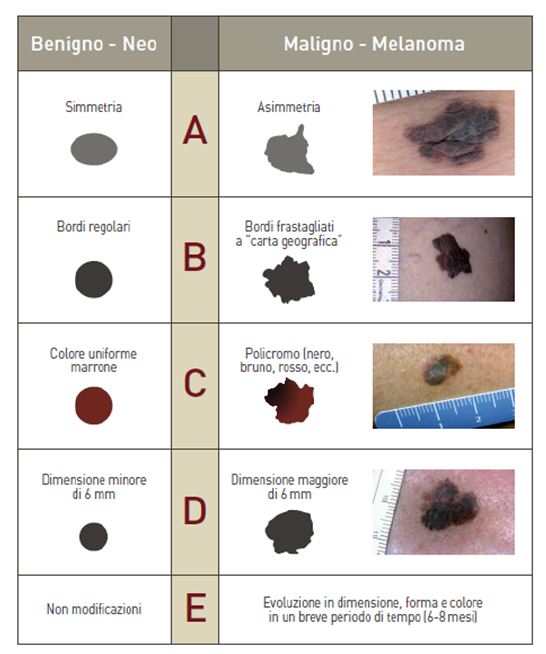 melanoma benigno e maligno