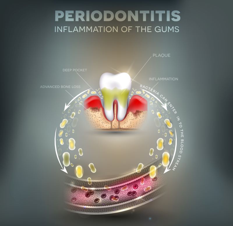 Diabete e parodontite